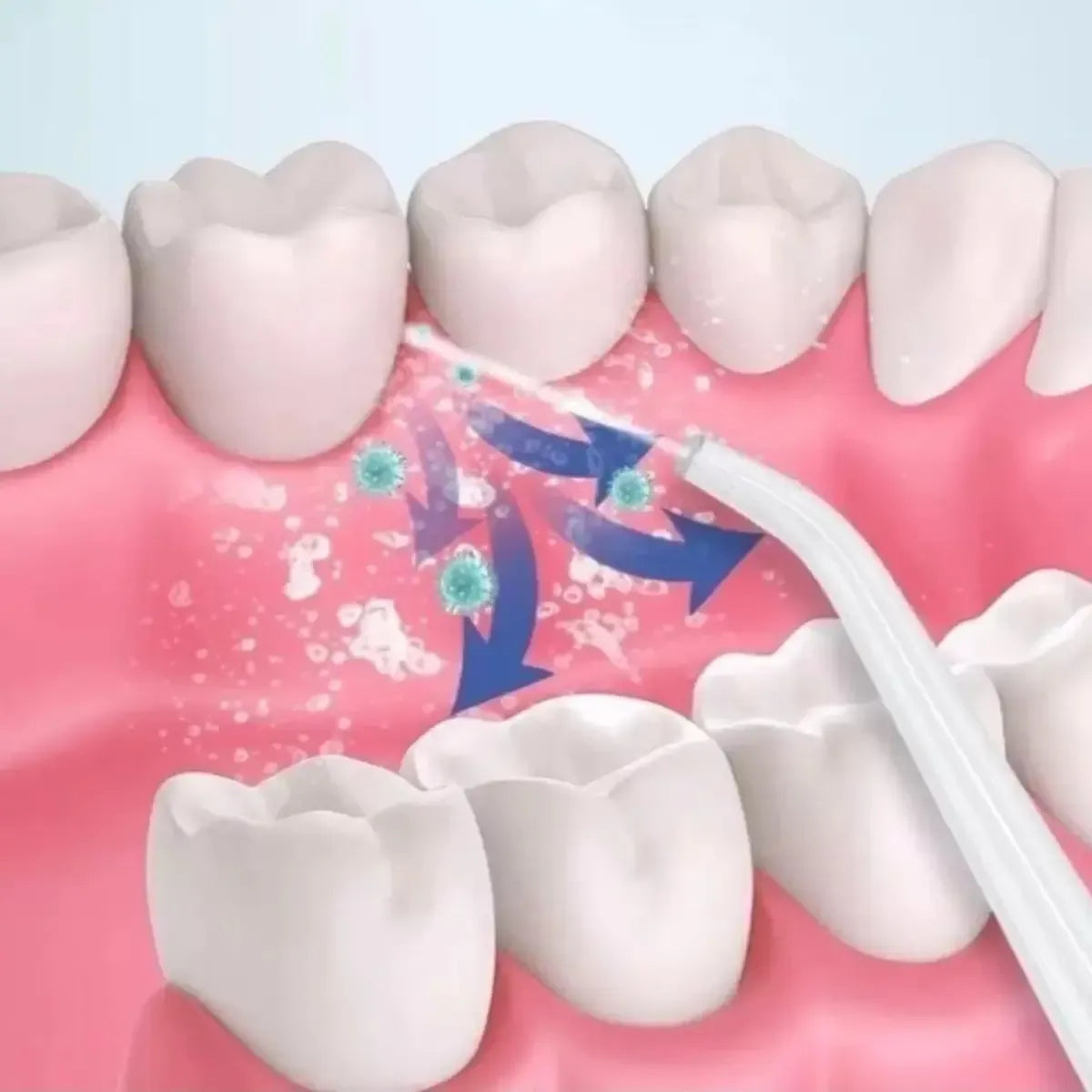 Limpieza bucal profunda con irrigador dental para encías brackets e implantes
