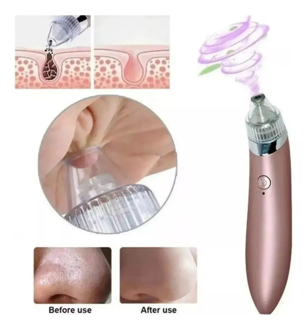 Removedor Extractor Puntos Negros Espinillas Limpieza Facial